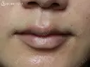 【20代女性・自然な印象の良い口元に】プレミアム口角挙上術（1ヶ月後） before画像 サムネイル用