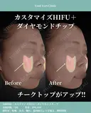 HIFU＋ダイヤモンドチップ before画像 サムネイル用