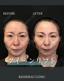 クイーンリフト（糸リフト） before画像 サムネイル用