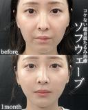 ソフウェーブ before画像 サムネイル用