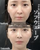 ソフウェーブ 30日後 サムネイル用