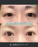 MT埋没法 3点留め+目頭切開 before画像 サムネイル用