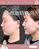 スタンダード小顔脂肪吸引(あご下・エラ下) 90日後 サムネイル用