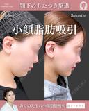 スタンダード小顔脂肪吸引(あご下・エラ下) before画像 サムネイル用