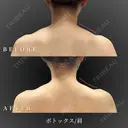 肩ボトックス 60日後 サムネイル用