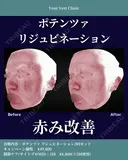 ポテンツァリジュビネーション before画像 サムネイル用