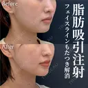 脂肪吸引注射 after画像 サムネイル用