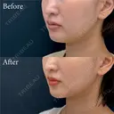脂肪吸引注射 after画像 サムネイル用
