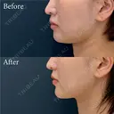 脂肪吸引注射 after画像 サムネイル用