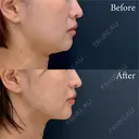 脂肪吸引注射 after画像 サムネイル用