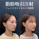 脂肪吸引注射 after画像 サムネイル用