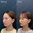 脂肪吸引注射 after画像 サムネイル用