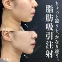 脂肪吸引注射 after画像 サムネイル用