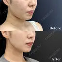 脂肪吸引注射 after画像 サムネイル用