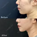 脂肪吸引注射 after画像 サムネイル用