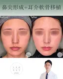 鼻尖形成+耳介軟骨移植 after画像 サムネイル用