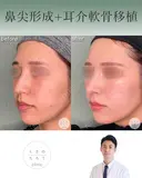 鼻尖形成+耳介軟骨移植 after画像 サムネイル用