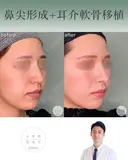 鼻尖形成+耳介軟骨移植 after画像 サムネイル用