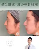 鼻尖形成+耳介軟骨移植 after画像 サムネイル用