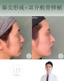 鼻尖形成+耳介軟骨移植 after画像 サムネイル用