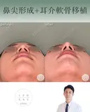 鼻尖形成+耳介軟骨移植 after画像 サムネイル用