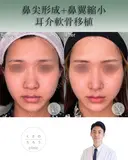 鼻尖形成+耳介軟骨移植+鼻翼縮小 before画像 サムネイル用
