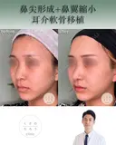 鼻尖形成+耳介軟骨移植+鼻翼縮小 after画像 サムネイル用