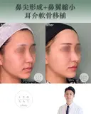 鼻尖形成+耳介軟骨移植+鼻翼縮小 after画像 サムネイル用