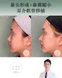 鼻尖形成+耳介軟骨移植+鼻翼縮小 after画像 サムネイル用