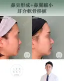 鼻尖形成+耳介軟骨移植+鼻翼縮小 after画像 サムネイル用