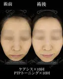 PTPトーニング/ケアシス before画像 サムネイル用