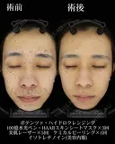 ポテンツァ/ハイドロクレンジング/100億水光ペン/HAABスキンシートマスク/美肌レーザー/ケミカルピーリング/イソトレチノイン before画像 サムネイル用
