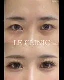 二重埋没 before画像 サムネイル用