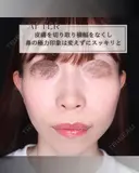 鼻翼縮小 after画像 サムネイル用