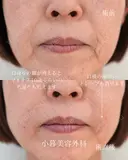 法令線ヒアルロン酸　マリオネットヒアルロン酸　顎ボトックス before画像 サムネイル用