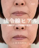 法令線ヒアルロン酸　マリオネットヒアルロン酸　顎ボトックス 0日後 サムネイル用