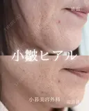 法令線ヒアルロン酸 0日後 サムネイル用