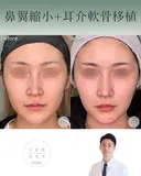 鼻翼縮小＋耳介軟骨移植 after画像 サムネイル用