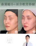 鼻翼縮小＋耳介軟骨移植 after画像 サムネイル用