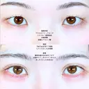 アリエルクイックループトリプル二重埋没法/目頭切開/涙袋ヒアルロン酸 before画像 サムネイル用