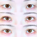 アリエルクイックループトリプル二重埋没法/目頭切開/涙袋ヒアルロン酸 30日後 サムネイル用