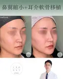 鼻翼縮小＋耳介軟骨移植 after画像 サムネイル用