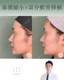 鼻翼縮小＋耳介軟骨移植 after画像 サムネイル用