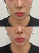 顎ヒアルロン酸 before画像 サムネイル用