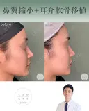 鼻翼縮小＋耳介軟骨移植 after画像 サムネイル用
