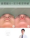 鼻翼縮小＋耳介軟骨移植 after画像 サムネイル用