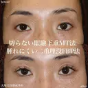 切らない眼瞼下垂MT法+腫れにくい二重埋没FBP法 after画像 サムネイル用