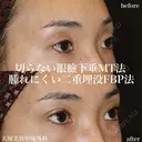 切らない眼瞼下垂MT法+腫れにくい二重埋没FBP法 after画像 サムネイル用