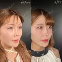 鼻整形－複合－ after画像 サムネイル用