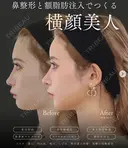 鼻整形(隆鼻術・鼻尖形成術・鼻先軟骨移植・移植物抜去)/額脂肪注入（コンデンスリッチフェイス） before画像 サムネイル用